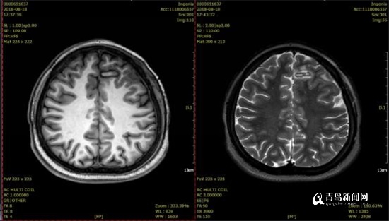 点赞!新技术治愈癫痫病 齐鲁医院(青岛)开创省内先河